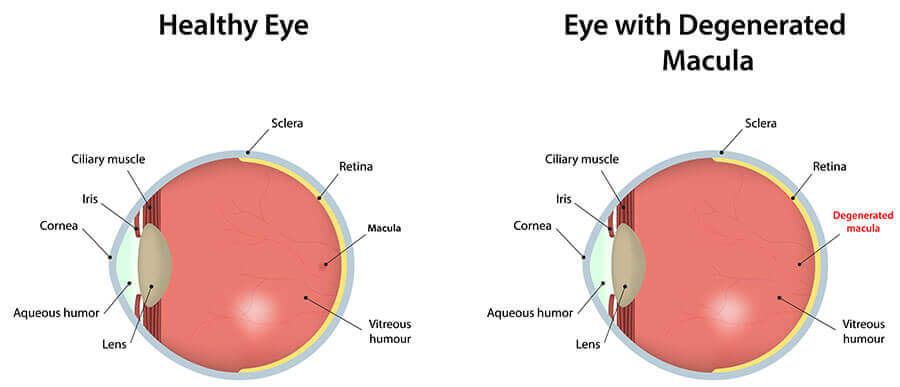 Chart Illustrating a Healthy Eye vs One With a Degenerated Macula